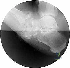 صورة توضيحية لـ علاج قدم شاركو المعقدة: تقنية التصحيح التدريجي بالحد الأدنى من التدخل الجراحي ودمج المفاصل