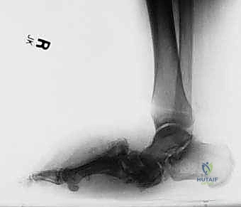 متابعة التئام العظام بالأشعة الدورية