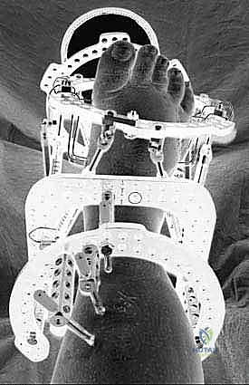 صورة توضيحية لـ علاج قدم شاركو المعقدة: تقنية التصحيح التدريجي بالحد الأدنى من التدخل الجراحي ودمج المفاصل