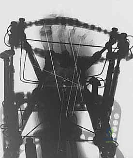 التصحيح التدريجي باستخدام التثبيت الخارجي