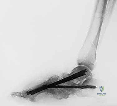 علاج قدم شاركو المعقدة: تقنية التصحيح التدريجي بالحد الأدنى من التدخل الجراحي ودمج المفاصل