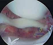 إصلاح وإعادة بناء الرباط الجانبي الإنسي للركبة: دليلك الشامل مع الأستاذ الدكتور محمد هطيف