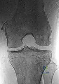 صورة توضيحية لـ إصلاح وإعادة بناء الرباط الجانبي الإنسي للركبة: دليلك الشامل مع الأستاذ الدكتور محمد هطيف