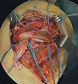 التشخيص الدقيق لتمزق الرباط الجانبي الإنسي باستخدام الرنين المغناطيسي