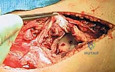 صورة توضيحية لـ إصلاح وإعادة بناء الرباط الجانبي الإنسي للركبة: دليلك الشامل مع الأستاذ الدكتور محمد هطيف