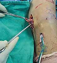 صورة توضيحية لـ إصلاح وإعادة بناء الرباط الجانبي الإنسي للركبة: دليلك الشامل مع الأستاذ الدكتور محمد هطيف