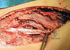 آلية إصابة الرباط الجانبي الإنسي للركبة والضغط الخارجي