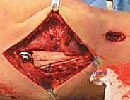 صورة توضيحية لـ إصلاح وإعادة بناء الرباط الجانبي الإنسي للركبة: دليلك الشامل مع الأستاذ الدكتور محمد هطيف