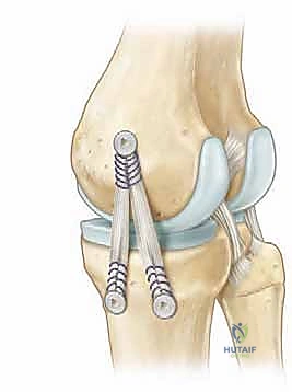 صورة توضيحية لـ إصلاح وإعادة بناء الرباط الجانبي الإنسي للركبة: دليلك الشامل مع الأستاذ الدكتور محمد هطيف