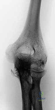 Illustration of patients with ra - Dr. Mohammed Hutaif