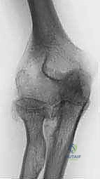 تآكل الغضاريف والعظام في المرفق