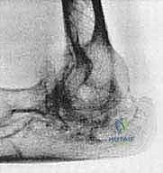 مراحل تدمير المفصل بسبب الروماتويد