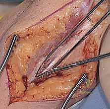 الأستاذ الدكتور محمد هطيف أثناء التخطيط الجراحي