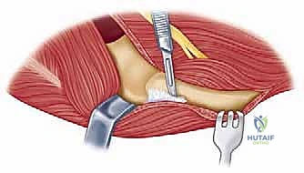 تحضير القناة النخاعية للعظام