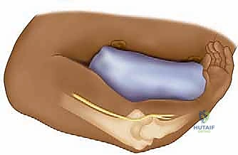 عزل وحماية العصب الزندي