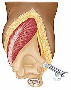 أجزاء المفصل الصناعي للمرفق