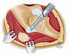 تجميع أجزاء المفصل الصناعي