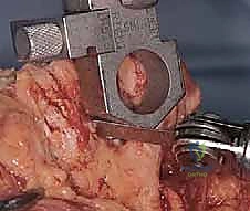 استبدال مفصل المرفق الكلي لالتهاب المفاصل الروماتويدي: دليل شامل للمرضى