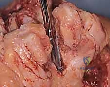 صورة طبية: استبدال مفصل المرفق الكلي لالتهاب المفاصل الروماتويدي: دليل شامل للمرضى