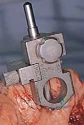 صورة توضيحية لـ استبدال مفصل المرفق الكلي لالتهاب المفاصل الروماتويدي: دليل شامل للمرضى