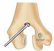 إغلاق الجرح الجراحي