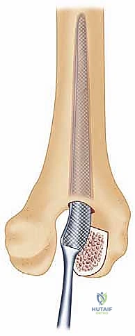 صورة طبية: استبدال مفصل المرفق الكلي لالتهاب المفاصل الروماتويدي: دليل شامل للمرضى