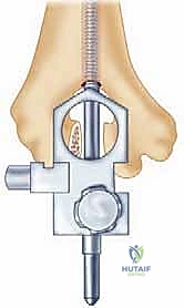 صورة طبية: استبدال مفصل المرفق الكلي لالتهاب المفاصل الروماتويدي: دليل شامل للمرضى
