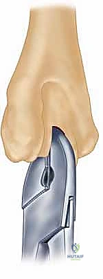 صورة طبية: استبدال مفصل المرفق الكلي لالتهاب المفاصل الروماتويدي: دليل شامل للمرضى