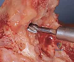 صورة طبية: استبدال مفصل المرفق الكلي لالتهاب المفاصل الروماتويدي: دليل شامل للمرضى