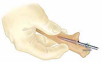 مقارنة النتائج قبل وبعد الجراحة