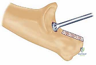 صورة توضيحية لـ استبدال مفصل المرفق الكلي لالتهاب المفاصل الروماتويدي: دليل شامل للمرضى