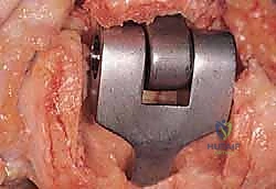 صورة توضيحية لـ استبدال مفصل المرفق الكلي لالتهاب المفاصل الروماتويدي: دليل شامل للمرضى