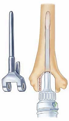 صورة توضيحية لـ استبدال مفصل المرفق الكلي لالتهاب المفاصل الروماتويدي: دليل شامل للمرضى