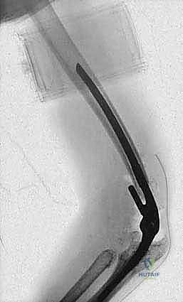 خطوة جراحية إضافية توضح دقة العمل