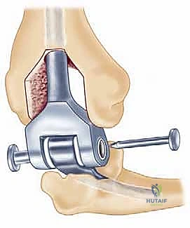 التشريح العظمي لمفصل المرفق