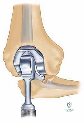 صورة توضيحية لـ استبدال مفصل المرفق الكلي لالتهاب المفاصل الروماتويدي: دليل شامل للمرضى