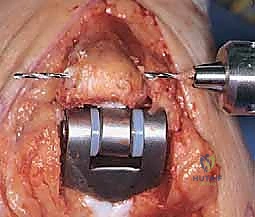 صورة طبية: استبدال مفصل المرفق الكلي لالتهاب المفاصل الروماتويدي: دليل شامل للمرضى