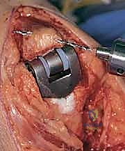 صورة طبية: استبدال مفصل المرفق الكلي لالتهاب المفاصل الروماتويدي: دليل شامل للمرضى