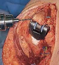 صورة طبية: استبدال مفصل المرفق الكلي لالتهاب المفاصل الروماتويدي: دليل شامل للمرضى