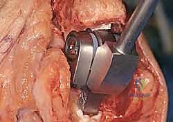 إزالة الأسطح العظمية التالفة