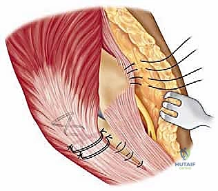 صورة طبية: استبدال مفصل المرفق الكلي لالتهاب المفاصل الروماتويدي: دليل شامل للمرضى