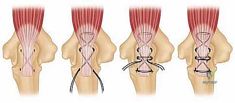 صورة توضيحية لـ استبدال مفصل المرفق الكلي لالتهاب المفاصل الروماتويدي: دليل شامل للمرضى