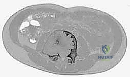 صورة مقطعية ورنين مغناطيسي لكيس عظم متمدد
