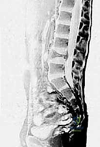 صورة رنين مغناطيسي لكيس عظم أحادي الغرفة