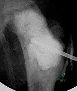 صورة توضيحية لـ أكياس العظام الحميدة: دليل شامل للتشخيص والعلاج الجراحي مع الأستاذ الدكتور محمد هطيف في صنعاء