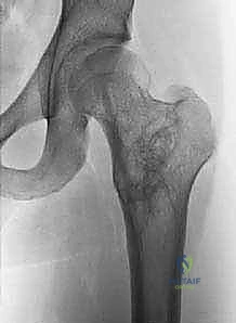 صورة توضيحية لـ أكياس العظام الحميدة: دليل شامل للتشخيص والعلاج الجراحي مع الأستاذ الدكتور محمد هطيف في صنعاء