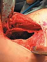 صورة طبية: أكياس العظام الحميدة: دليل شامل للتشخيص والعلاج الجراحي مع الأستاذ الدكتور محمد هطيف في صنعاء