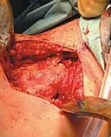 Masterclass: Surgical Management of Benign Bone Cysts – UBC and ABC