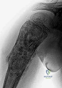 صورة طبية: أكياس العظام الحميدة: دليل شامل للتشخيص والعلاج الجراحي مع الأستاذ الدكتور محمد هطيف في صنعاء