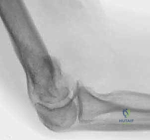 الأشعة السينية والتشخيص الأولي